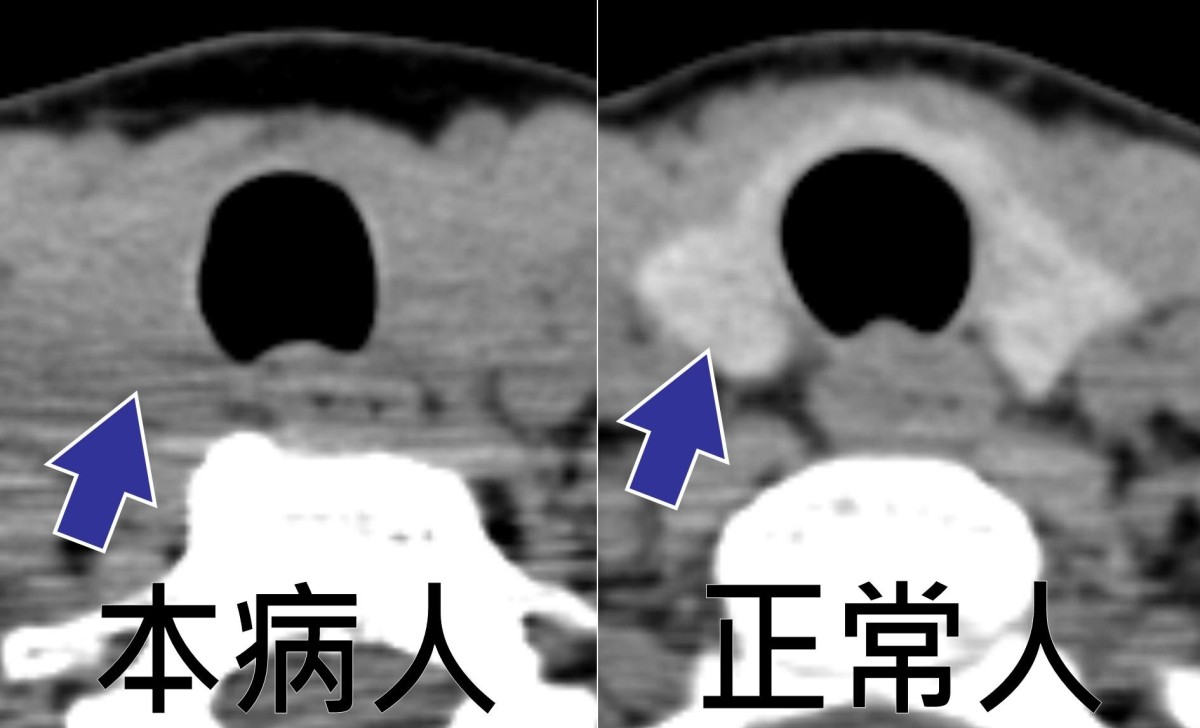 台湾高雄元景耳鼻喉科神经科成功诊断複杂耳鸣案例：自体免疫性甲状腺炎与耳蜗病变